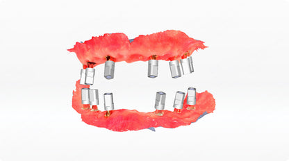 IPG intraoral  photogrametrie  shining 3D dental scanner.  AoralScan elite wireless